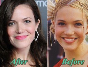 Mandy Moore before and after plastic surgery