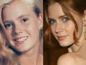 Amy Adams before and after plastic surgery