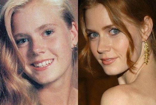 Amy Adams before and after plastic surgery.