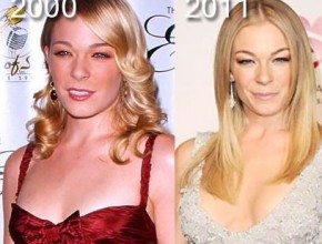 LeAnn Rimes before and after plastic surgery 2