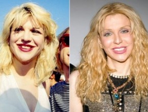 Courtney Love before and after plastic surgery