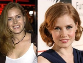 Amy Adams before and after plastic surgery