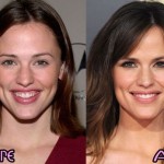 Jennifer Garner before and after plastic surgery