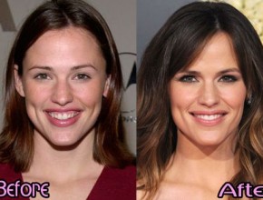 Jennifer Garner before and after plastic surgery