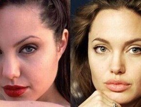 Angelina Jolie before and after plastic surgery 03