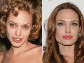 Angelina Jolie before and after plastic surgery 04
