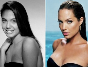 Angelina Jolie before and after plastic surgery 05