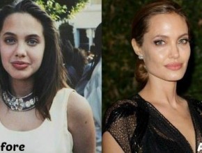 Angelina Jolie before and after plastic surgery 06