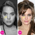 Angelina Jolie before and after plastic surgery