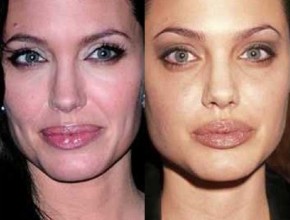 Angelina Jolie before and after plastic surgery 08