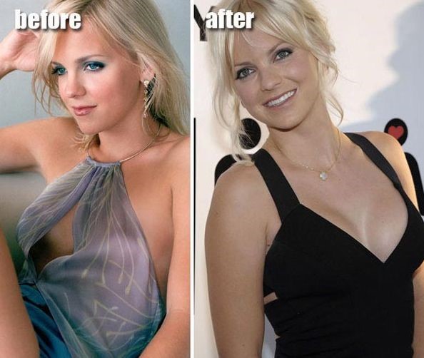 Anna Faris before and after plastic surgery