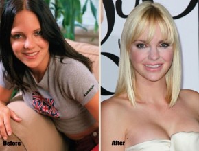 Anna Faris before and after plastic surgery 03