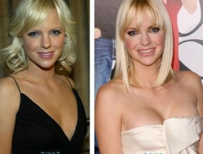 Anna Faris before and after plastic surgery