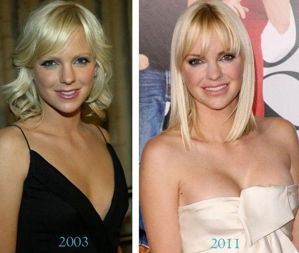 Anna Faris before and after plastic surgery