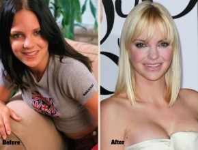 Anna Faris before and after plastic surgery 10