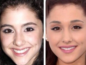 Ariana Grande before and after plastic surgery 02