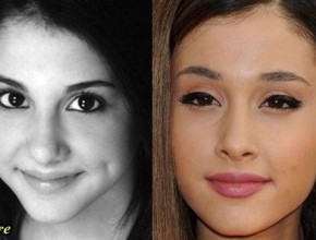 Ariana Grande before and after plastic surgery 03