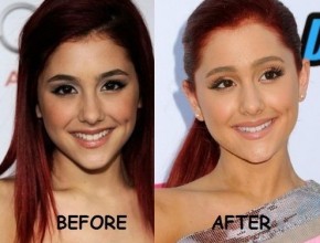 Ariana Grande before and after plastic surgery 04