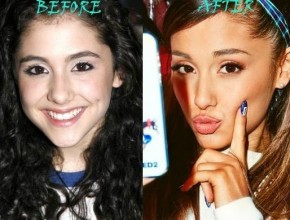 Ariana Grande before and after plastic surgery