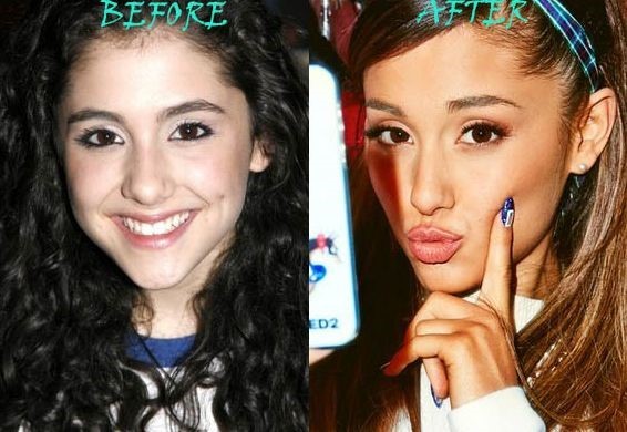 Ariana Grande before and after plastic surgery.