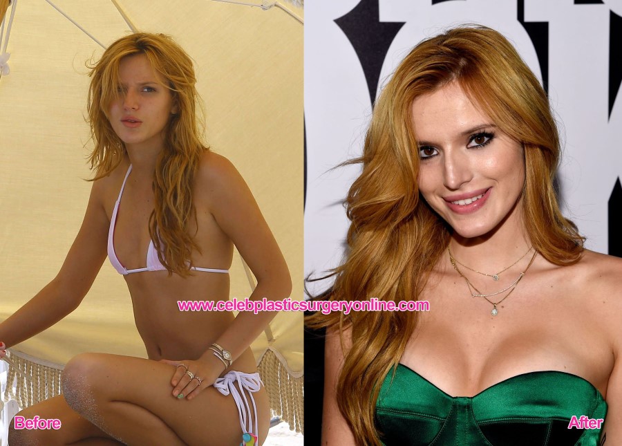 Bella Thorne before and after breasts augmentation Celebrity plastic surger...