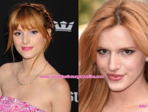 Bella Thorne before and after lip augmentation