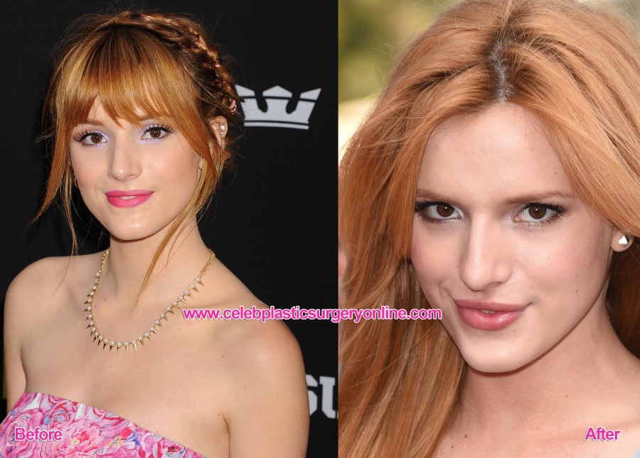 Bella Thorne before and after lip augmentation.