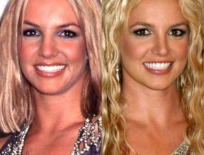 Britney Spears before and after plastic surgery 01