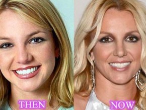 Britney Spears before and after plastic surgery 02