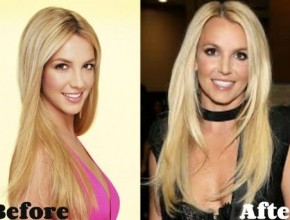 Britney Spears before and after plastic surgery 06