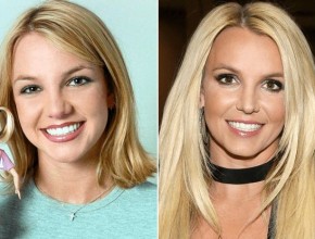 Britney Spears before and after plastic surgery