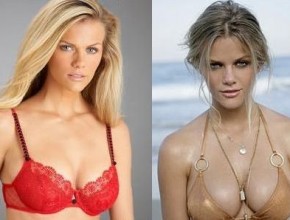 Brooklyn Decker before and after plastic surgery