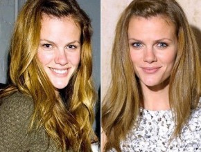 Brooklyn Decker before and after plastic surgery 02