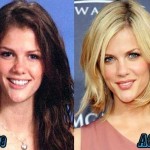 Brooklyn Decker before and after plastic surgery 03