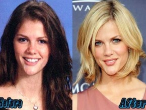 Brooklyn Decker before and after plastic surgery 03
