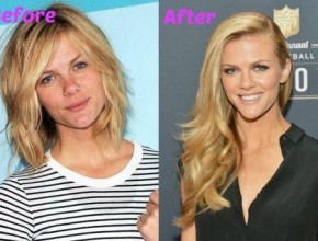 Brooklyn Decker before and after plastic surgery