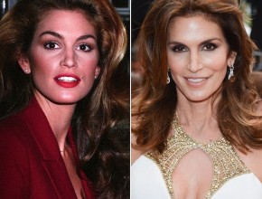 Cindy Crawford before and after plastic surgery 02