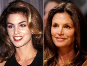 Cindy Crawford before and after plastic surgery 03