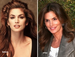 Cindy Crawford before and after plastic surgery