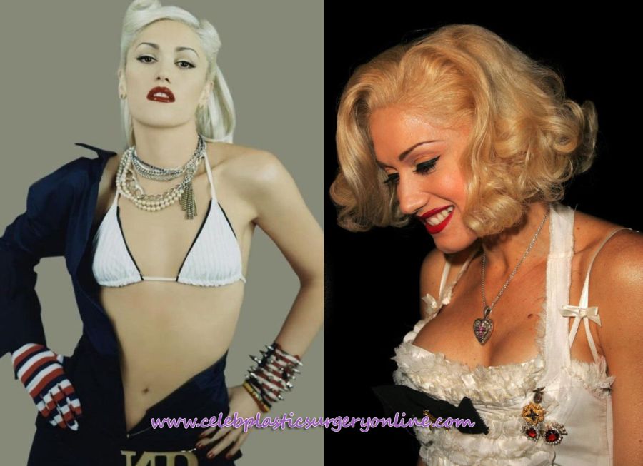 Gwen Stefani after breast augmentation