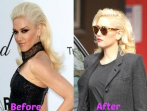 Gwen Stefani before and after plastic surgery 02