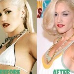 Gwen Stefani before and after plastic surgery 04