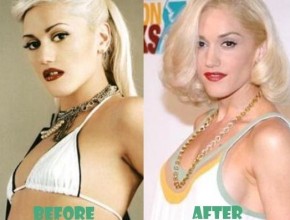 Gwen Stefani before and after plastic surgery 04