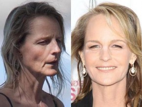 Helen Hunt before and after plastic surgery