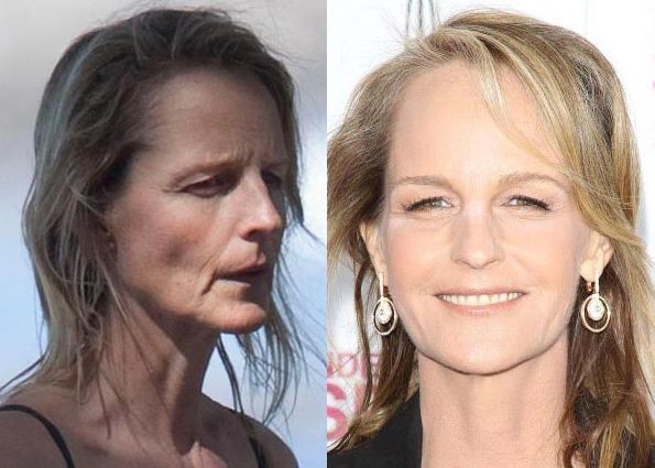 Helen Hunt before and after plastic surgery