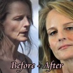 Helen Hunt before and after plastic surgery 03