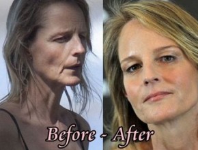 Helen Hunt before and after plastic surgery 03