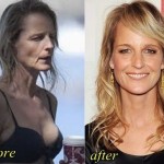 Helen Hunt before and after plastic surgery 05