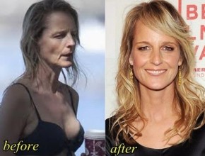 Helen Hunt before and after plastic surgery 05
