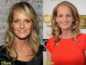 Helen Hunt before and after plastic surgery